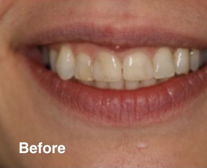 dentist in mexico prices dentist in mexico prices