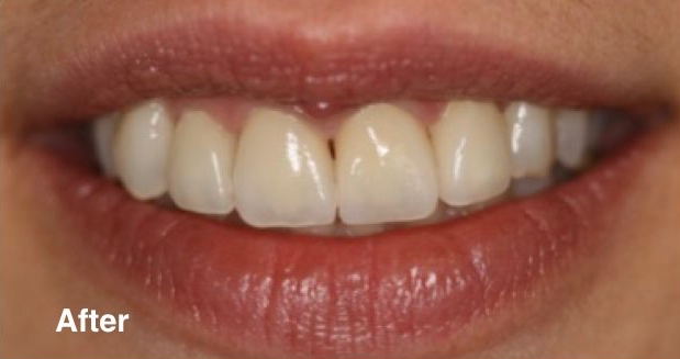 dentist in mexico prices dentist in mexico prices