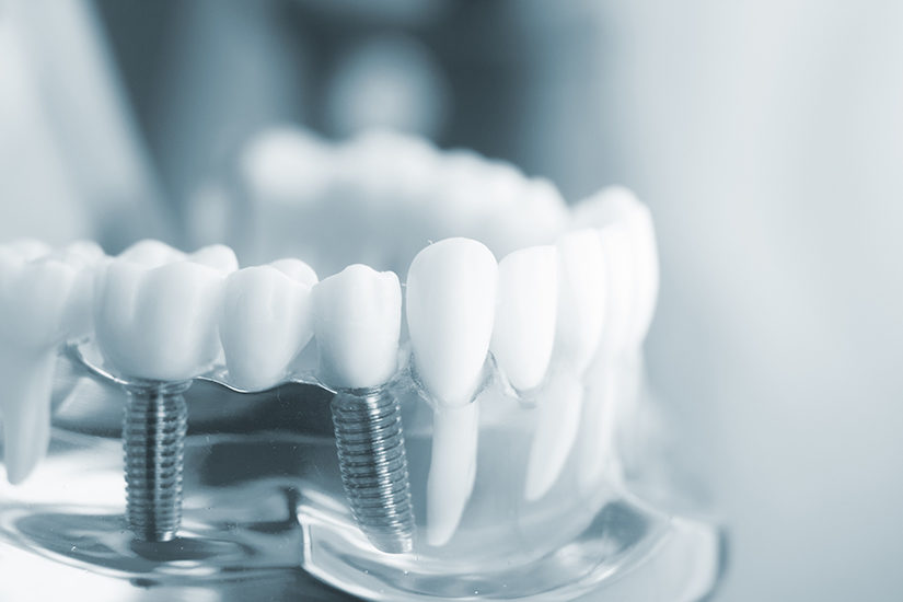 dentist in mexico prices dentist in mexico prices