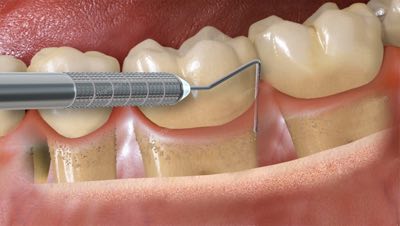 how to get dental work in mexico how to get dental work in mexico