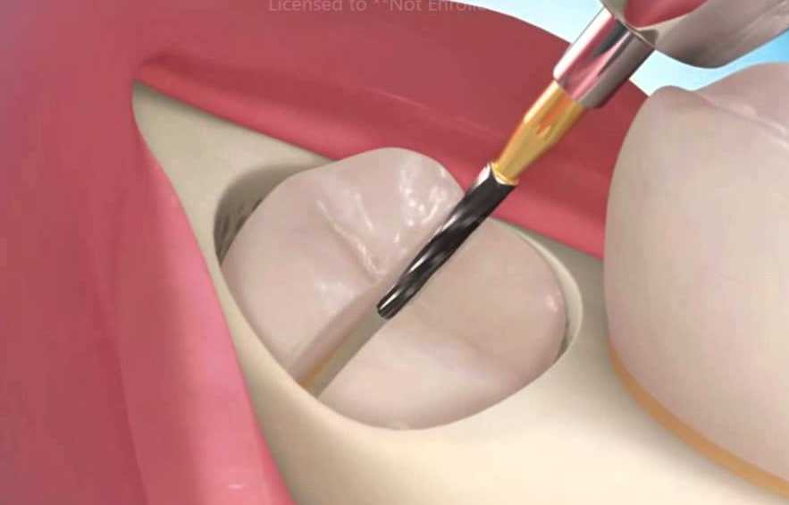 how to get dental work in mexico how to get dental work in mexico