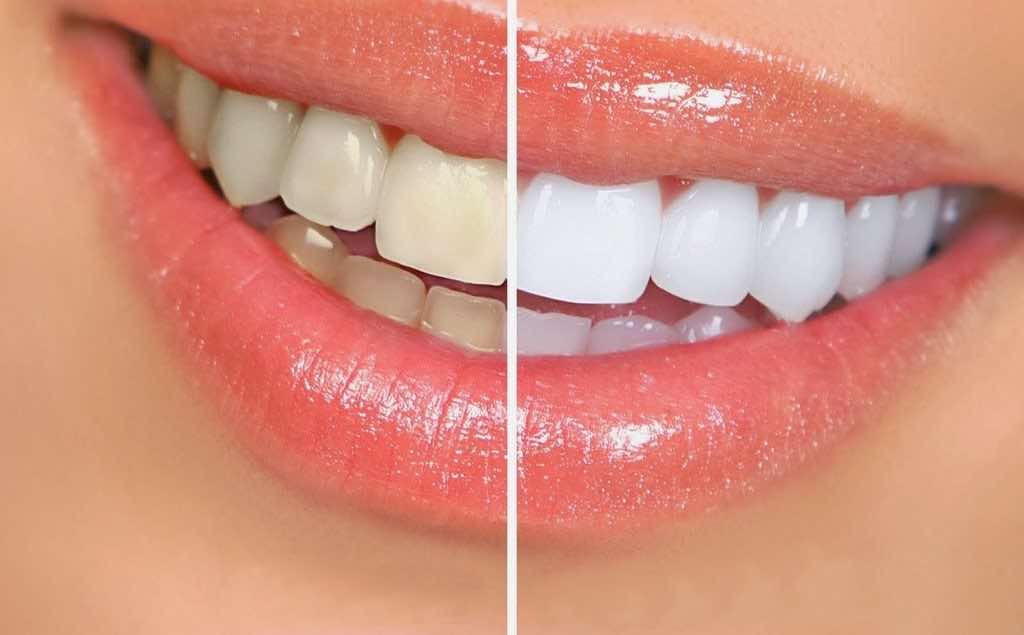 how to get dental work in mexico